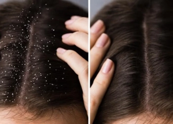 Hair tips: ਮੀਂਹ ਦੇ ਮੌਸਮ ਵਿੱਚ ਵੱਧ ਜਾਂਦੀ ਹੈ ਡੈਂਡਰਫ ਦੀ ਸਮੱਸਿਆ