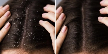 Hair tips: ਮੀਂਹ ਦੇ ਮੌਸਮ ਵਿੱਚ ਵੱਧ ਜਾਂਦੀ ਹੈ ਡੈਂਡਰਫ ਦੀ ਸਮੱਸਿਆ