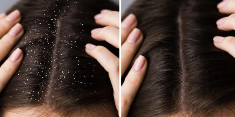 Hair tips: ਮੀਂਹ ਦੇ ਮੌਸਮ ਵਿੱਚ ਵੱਧ ਜਾਂਦੀ ਹੈ ਡੈਂਡਰਫ ਦੀ ਸਮੱਸਿਆ