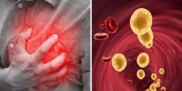 Health Tips : ਸਰੀਰ ‘ਚ ਕੋਲੈਸਟ੍ਰੋਲ ਦਾ ਪੱਧਰ ਵਧਣ ‘ਤੇ ਦਿਖਾਈ ਦੇਣ ਲੱਗਦੇ ਹਨ ਇਹ ਲੱਛਣ