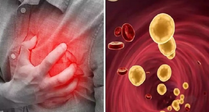 Health Tips : ਸਰੀਰ ‘ਚ ਕੋਲੈਸਟ੍ਰੋਲ ਦਾ ਪੱਧਰ ਵਧਣ ‘ਤੇ ਦਿਖਾਈ ਦੇਣ ਲੱਗਦੇ ਹਨ ਇਹ ਲੱਛਣ