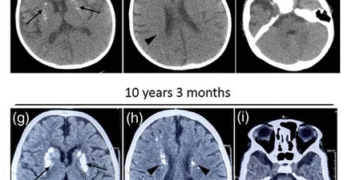 HEALTH & MEDICINE : ਭਾਰਤੀ ਖੋਜਕਰਤਾਵਾਂ ਨੇ ਬੱਚਿਆਂ ਵਿੱਚ ਵਾਰ-ਵਾਰ ਹੋਣ ਵਾਲੇ ਨਿਊਰੋਲੋਜੀਕਲ ਗਿਰਾਵਟ ਨਾਲ ਜੁੜੇ ਦੁਰਲੱਭ ਜੀਨ ਪਰਿਵਰਤਨ ਦੀ ਕੀਤੀ ਪਛਾਣ