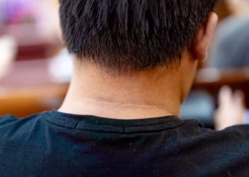 Health Tips : ਗਰਦਨ ‘ਤੇ ਦਿਖਣ ਵਾਲੀ ਕਾਲੀ ਲਕੀਰ ਨੂੰ ਨਾ ਕਰੋ ਨਜ਼ਰ ਅੰਦਾਜ਼; ਇਸ ਗੰਭੀਰ ਬਿਮਾਰੀ ਦਾ ਹੋ ਸਕਦਾ ਸੰਕੇਤ